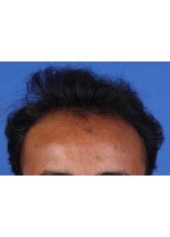 Before Hair Transplant&nbsp;Front